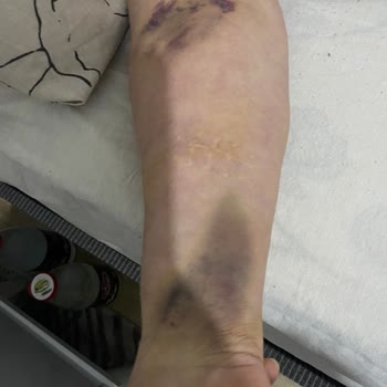 Atlas Hastanesi Kalp Krizi Şüphesiyle Giriş Yapan Hastanın Yoğun Bakım Hataları