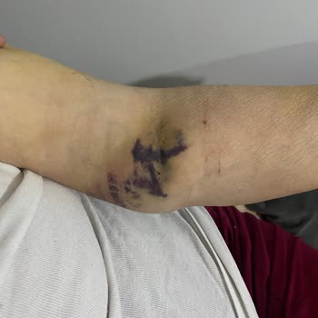 Atlas Hastanesi Kalp Krizi Şüphesiyle Giriş Yapan Hastanın Yoğun Bakım Hataları