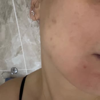 Estée Lauder Fondöteni Nedeniyle Şiddetli Sivilcelenme Ve Mağduriyet