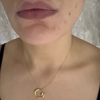 Estée Lauder Fondöteni Nedeniyle Şiddetli Sivilcelenme Ve Mağduriyet