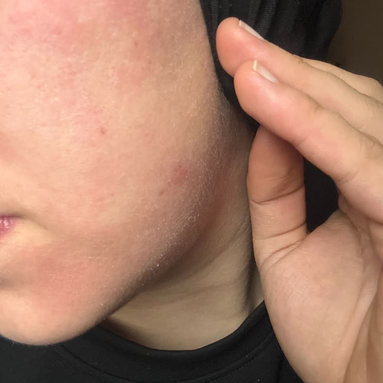 Bee Beauty Aydınlatıcı Toniği Sonrası Şiddetli Cilt Reaksiyonu Ve Sağlık Masrafları Talebi