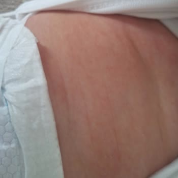 Mustela Yenidoğan Şampuanının Bebekte Egzama Yaratması