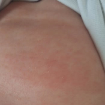 Mustela Yenidoğan Şampuanının Bebekte Egzama Yaratması