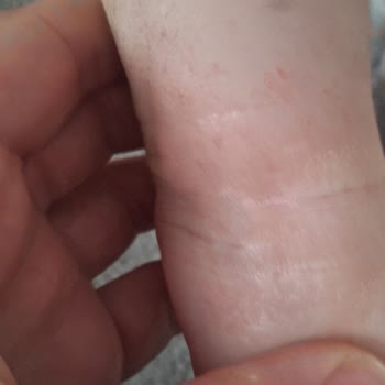 Mustela Yenidoğan Şampuanının Bebekte Egzama Yaratması