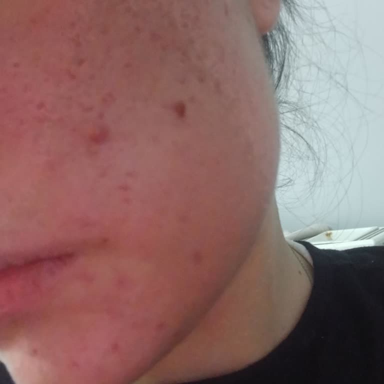 Bioderma Sebium Sensitive Ürününde Cilt Yanığı Ve Kalıcı İz Şikayeti