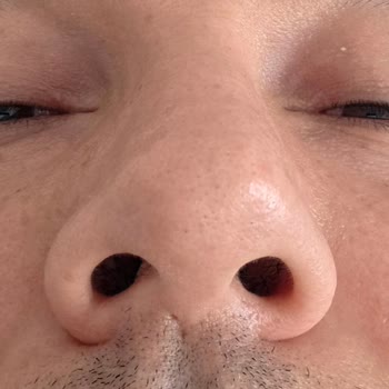 Op. Dr. Can Ercan Burun Ameliyatı Memnuniyetsizliği