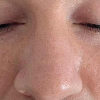 Op. Dr. Can Ercan Burun Ameliyatı Memnuniyetsizliği