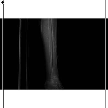Medicana Sağlık Grubu Beylikdüzü Hastanesinde Yanlış Röntgen Ve Uzun Alçı Süresi
