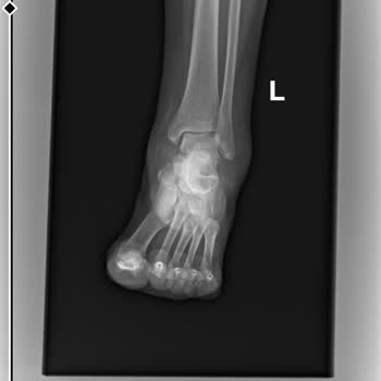 Medicana Sağlık Grubu Beylikdüzü Hastanesinde Yanlış Röntgen Ve Uzun Alçı Süresi