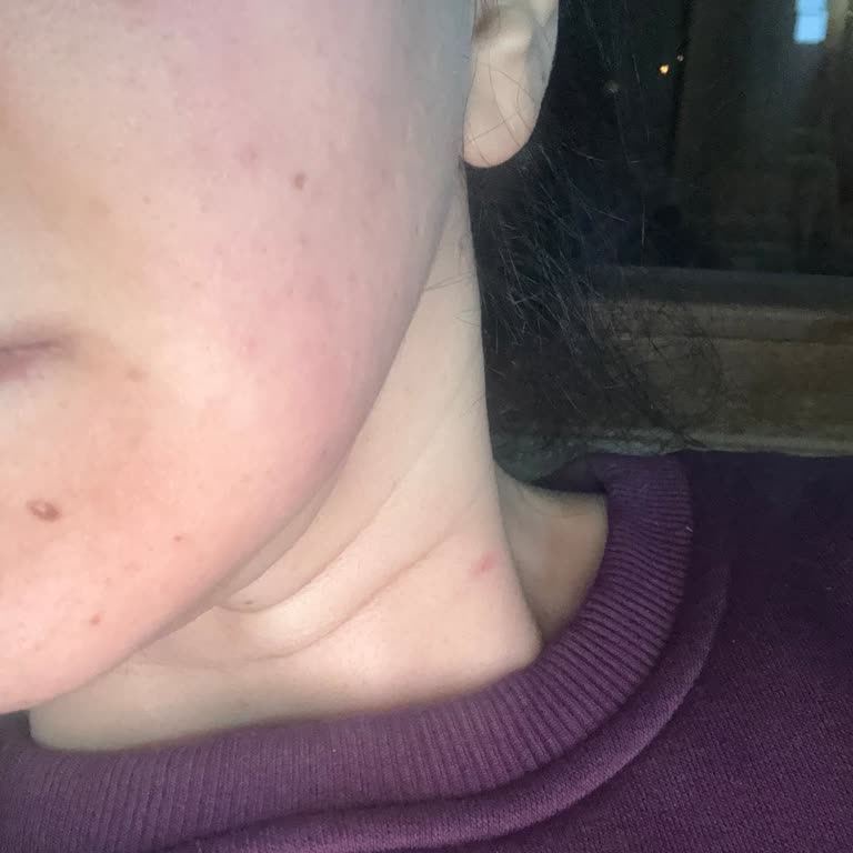 Arko Hyaluronik Yoğun Bakım Kremi Kullanımından Sonra Şiddetli Alerjik Reaksiyon Ve İade Talebi