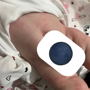 Bebekte Şiddetli Alerjik Reaksiyon Ve Kusma: Sma Optipro 1 İncelenmesini Talep Ediyorum