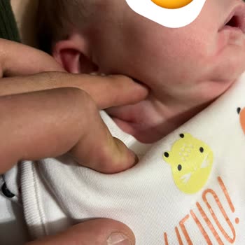 Bebekte Şiddetli Alerjik Reaksiyon Ve Kusma: Sma Optipro 1 İncelenmesini Talep Ediyorum