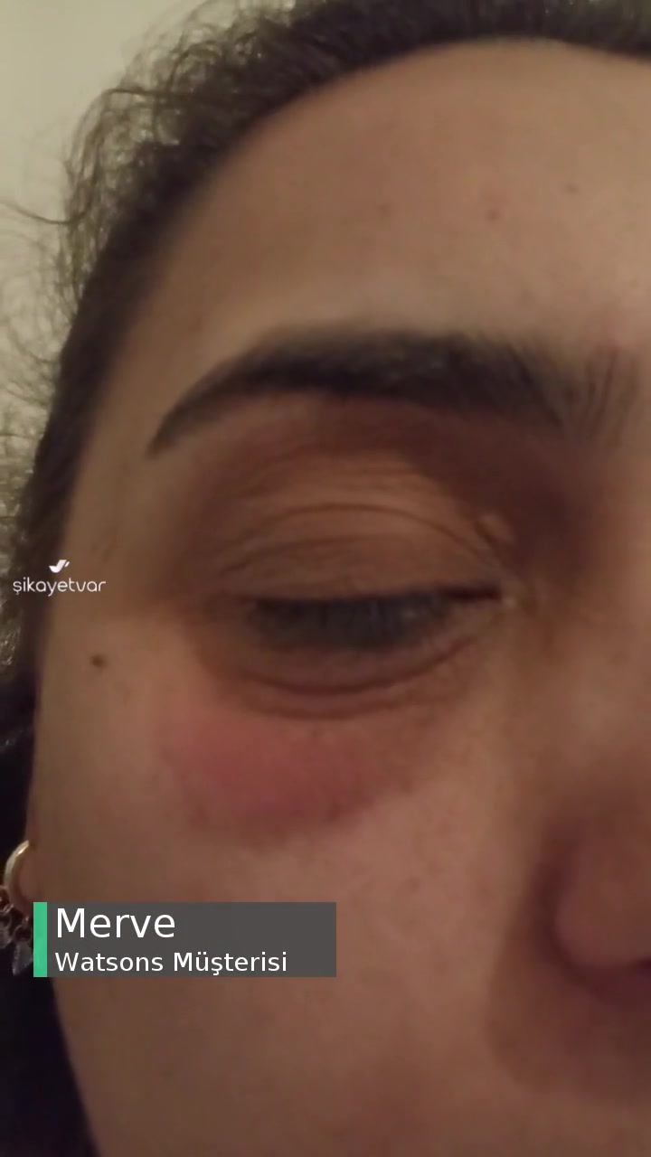 Watsons Yüz Yıkama Jeli Alerji Yaptı! videonun kapak resmi