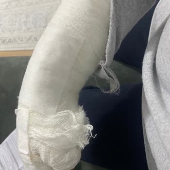 Acil Serviste X-Ray İhmali Ve Yetersiz Tedavi Nedeniyle Şiddetli Yaralanma