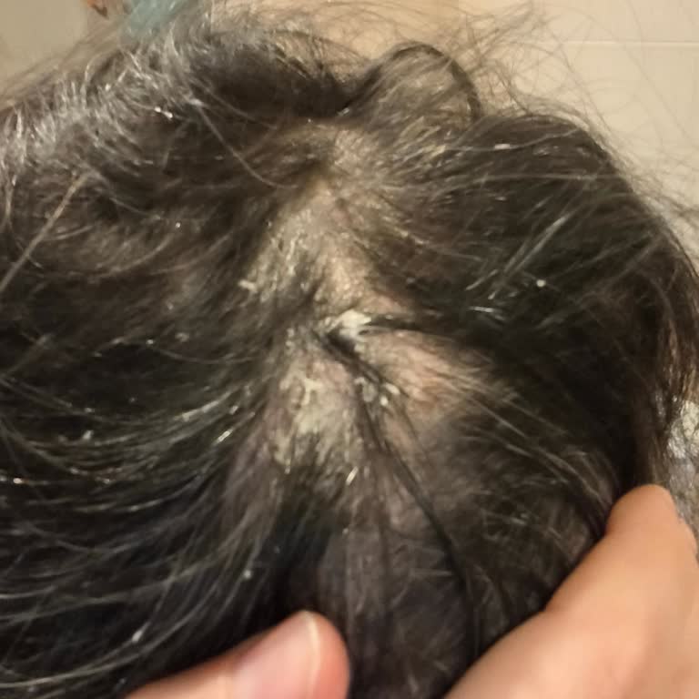 Vichy Dercos Şampuanı Saç Derisinde Şiddetli Kabuklanma Ve Dökülmeye Neden Oldu