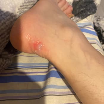 İlk Kullanımda Yara Açan Puma Ayakkabısı Ve Ayakkabı Dünyası’nın Çözüm Sunmayan Tutumu