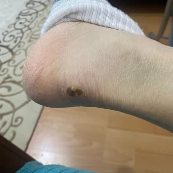 İlk Kullanımda Yara Açan Puma Ayakkabısı Ve Ayakkabı Dünyası’nın Çözüm Sunmayan Tutumu