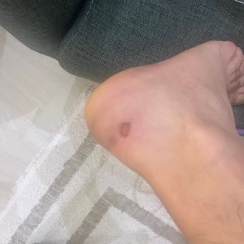 Keskin Topuk Bölümü Ayakta Kanamalara Neden Oldu, Değişim Ve İade Reddi Mağduriyetim