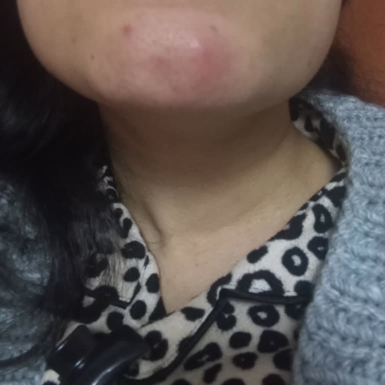 Nivea Leke Karşıtı Serum Kullanımından Sonra Şiddetli Sivilceler Ve Çözüm İsteği