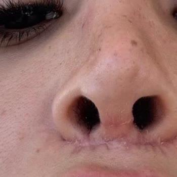 Estethica Kombine Burun Ve Lip Lift Ameliyatında Yanıltıcı Bilgilendirme Ve Kalıcı Estetik Hasar