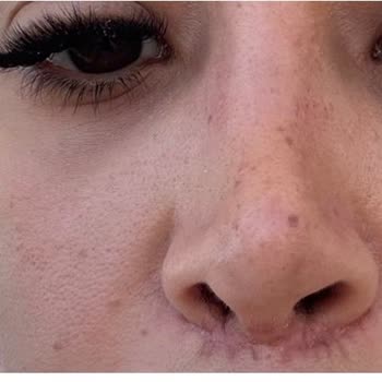 Estethica Kombine Burun Ve Lip Lift Ameliyatında Yanıltıcı Bilgilendirme Ve Kalıcı Estetik Hasar