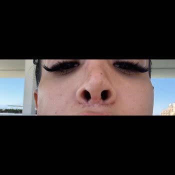 Estethica Kombine Burun Ve Lip Lift Ameliyatında Yanıltıcı Bilgilendirme Ve Kalıcı Estetik Hasar