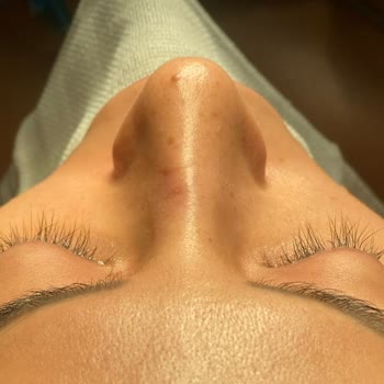 Estethica Kombine Burun Ve Lip Lift Ameliyatında Yanıltıcı Bilgilendirme Ve Kalıcı Estetik Hasar