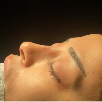 Estethica Kombine Burun Ve Lip Lift Ameliyatında Yanıltıcı Bilgilendirme Ve Kalıcı Estetik Hasar