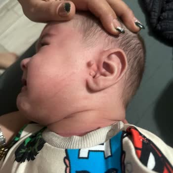 Fermuarı Güvensiz Polar Ceket Bebek Yüzünde Çizik Bıraktı
