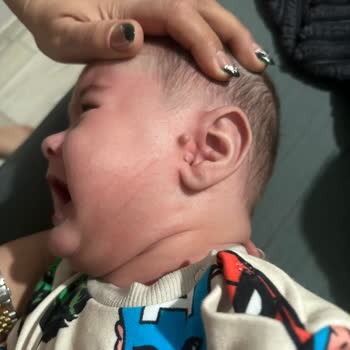 Fermuarı Güvensiz Polar Ceket Bebek Yüzünde Çizik Bıraktı