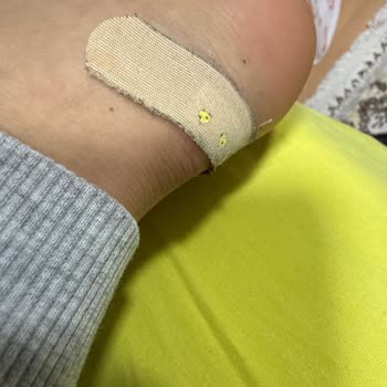 Kusurlu Deri Ayakkabının Yara Bırakması Ve İade Talebi