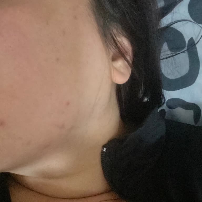 Krem Co Serum Kullanımında Beklenmedik Sivilceler Ve Güvenlik İncelemesi Talebi