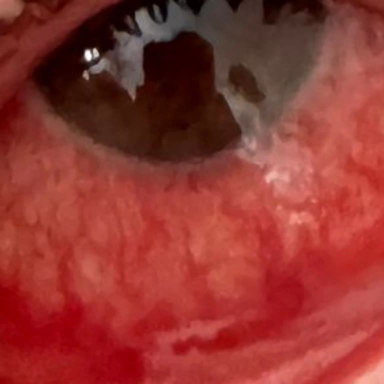 Fairy Kapsüllerinin Patlaması Göz Yaralanmalarına Neden Oluyor!