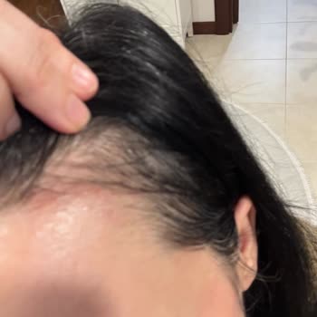 Ziaja Tonik Kullanımında Şiddetli Kaşıntı Ve Kızarıklık