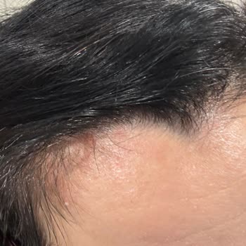 Ziaja Tonik Kullanımında Şiddetli Kaşıntı Ve Kızarıklık