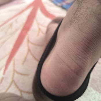 Ayakkabı Topuk Yaraları İade Ve Değişim Talebi