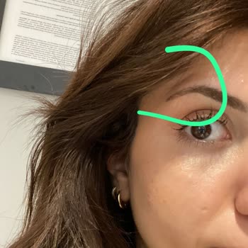 İlya Clinic’te Botoks Uygulamasının Etkisizliği, Güvenlik Endişesi Ve Ücret İadesi Talebi