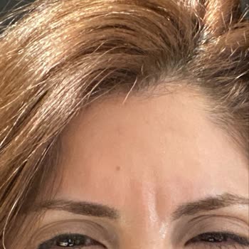 İlya Clinic’te Botoks Uygulamasının Etkisizliği, Güvenlik Endişesi Ve Ücret İadesi Talebi