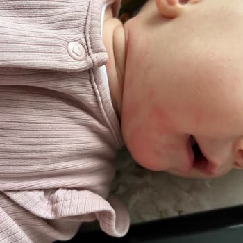 Bebek Mamasına Aşırı Hassasiyet Reaksiyonu Ve Ürün Güvenliği Şikayeti