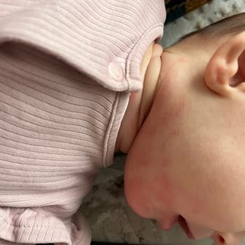 Bebek Mamasına Aşırı Hassasiyet Reaksiyonu Ve Ürün Güvenliği Şikayeti