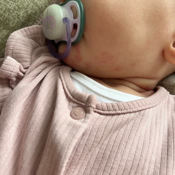 Bebek Mamasına Aşırı Hassasiyet Reaksiyonu Ve Ürün Güvenliği Şikayeti