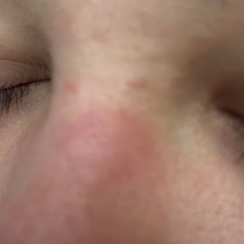 Şiddetli Kontak Dermatiti Ve Dudak Şişmesi Nedeniyle Bioderma Sensibio Micellar Su İadesi