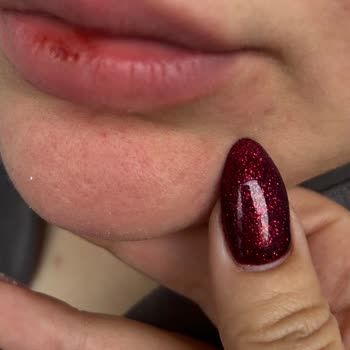 Şiddetli Kontak Dermatiti Ve Dudak Şişmesi Nedeniyle Bioderma Sensibio Micellar Su İadesi