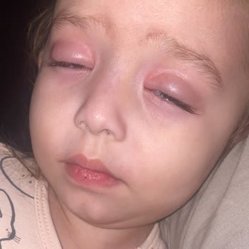 Çocuk Makyajı Gözlerde Şiddetli Alerji Ve Şişmeye Neden Oluyor