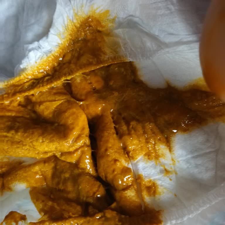 SMA Optipro Mamadan Şiddetli Kusma Ve Bağırsak Sorunları