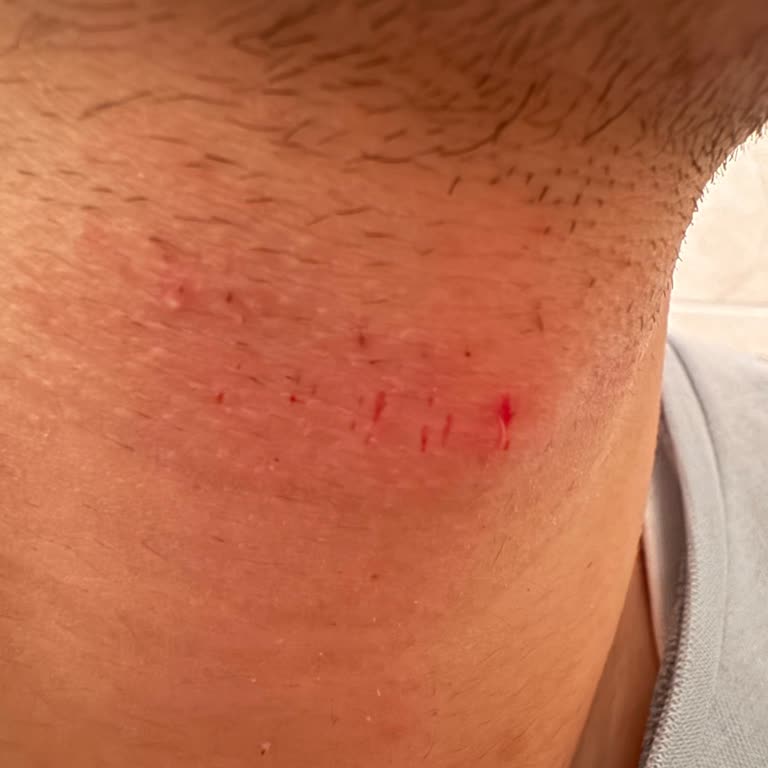 Philips OneBlade Koruma Başlığına Rağmen Sürekli Kesik Ve Tahriş