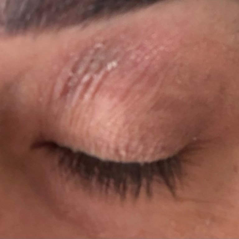 Göz Çevresinde Şiddetli Yanma, Kızarıklık Ve Kaşıntı Nedeniyle Para İadesi Talebi