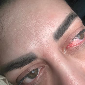 Fairy Kapsülü Patladı Gözüm Kızardı Ve Ürün Güvenliği Şikayetim