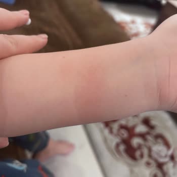 Çocuğumda Alerjik Reaksiyon Yaratan Saat Ücret İadesi Talebi