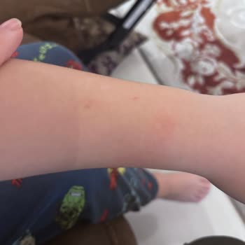 Çocuğumda Alerjik Reaksiyon Yaratan Saat Ücret İadesi Talebi